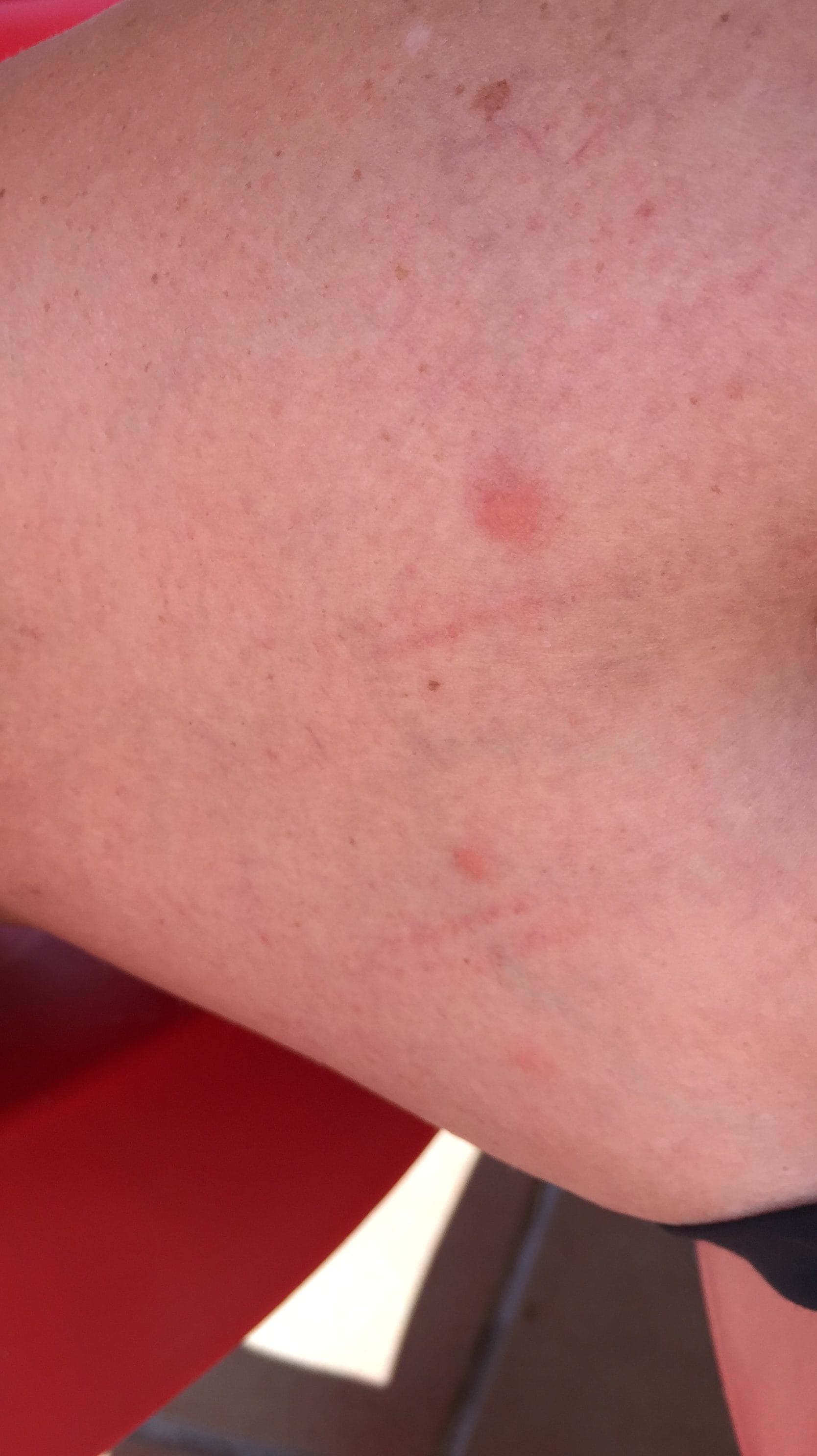 First signs of bedbug bites on legs